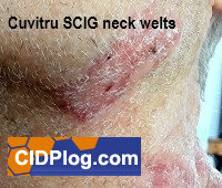 welts from ivig scig infusiond for cido